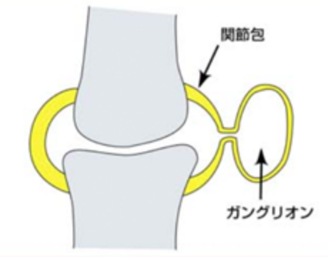 ガングリオンとは