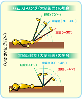 太もも前面（ハムストリング）と太ももの裏（大腿四頭筋）の肉離れ